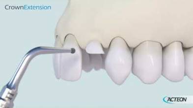 Surgery Crown Extension 3D protocol