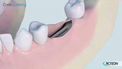 Surgery Crest Splitting 3D protocol