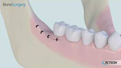 Bone Surgery 3D protocol