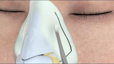 Ultrasonic Rhinoplasty