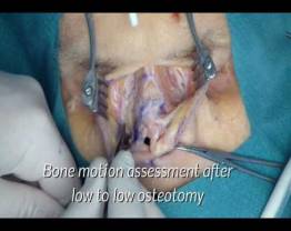 Cadaver Lab_Rhinoplasty osteotomies with Piezo intruments, Dr Gerbault, Vinecnnes, FRANCE