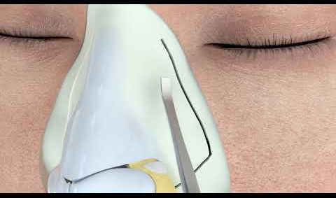 Ultrasonic Rhinoplasty